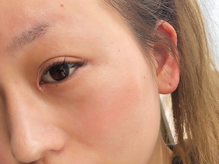 二重幅、頬、涙袋に（C）コクハク