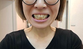 ワイヤー矯正装着2週間、バゲット食らうコツを取得 2023.6.13（火）