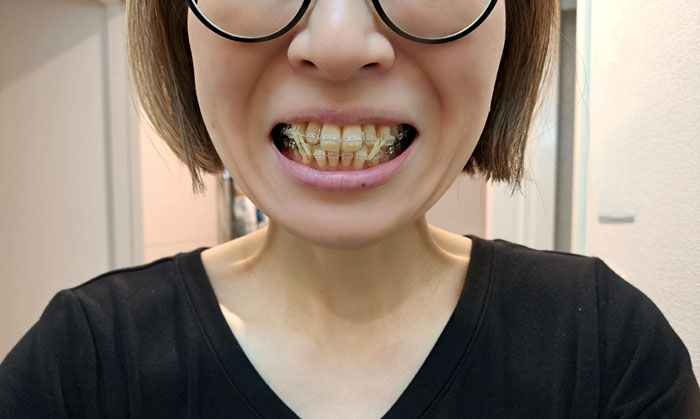 第一段階のワイヤー装着（緩めのタイプ）／（C）コクハク