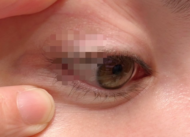 できやすい体質もあるんですって（C）コクハク