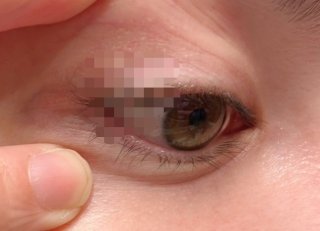 「たかが、ものもらい」じゃなかった 30代女、霰粒腫の手術をしました