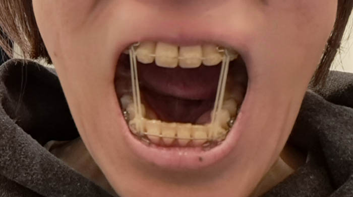 シャー！ お目汚し、失礼をいたします。食事時以外は「ゴムかけ」をする日々。本人的にはギョっとされることも慣れっこです（C）コクハク