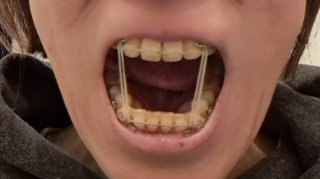 【45歳からの歯科矯正】医療費控除の手続き、確定申告で役に立つアレ