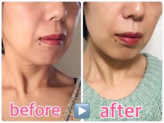 40女、ヒアルロン酸で若返る?12万円をほうれい線治療にブッ込んだら…