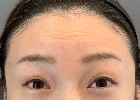 ボトックス前（イートップクリニック提供／無断転載禁止）