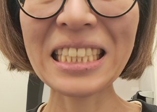 【45歳からの歯科矯正】2年後の47歳でひとまず終了。ワイヤー矯正をやって後悔、失敗したことは?