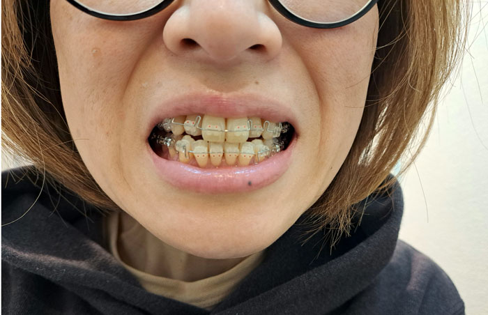 ワイヤー矯正中（C）コクハク