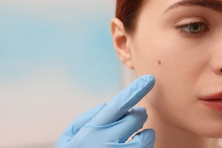 加齢で増えがちな「ほくろ」はシミと何が違う?【美容外科医が解説】電気メスで削ると? 保険適用の条件は?